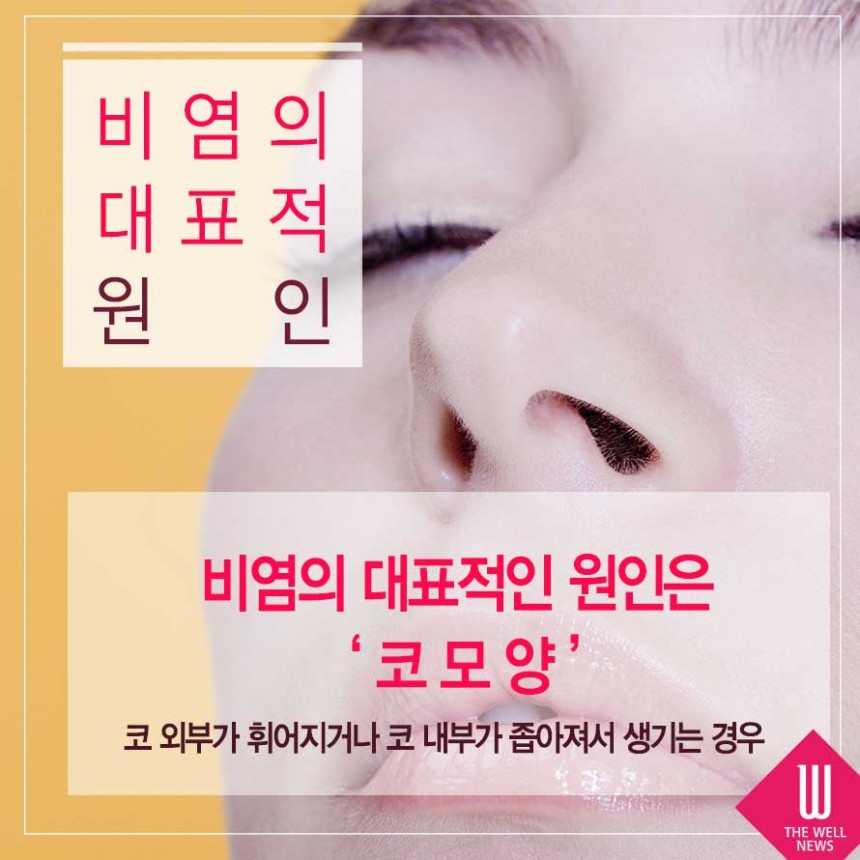 비염을 성형으로 치료한다고요? (2/7)