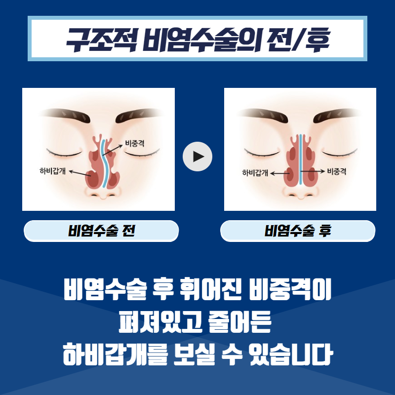 [비염치료] 비염 수술을 해야 하는 이유 (5/12)