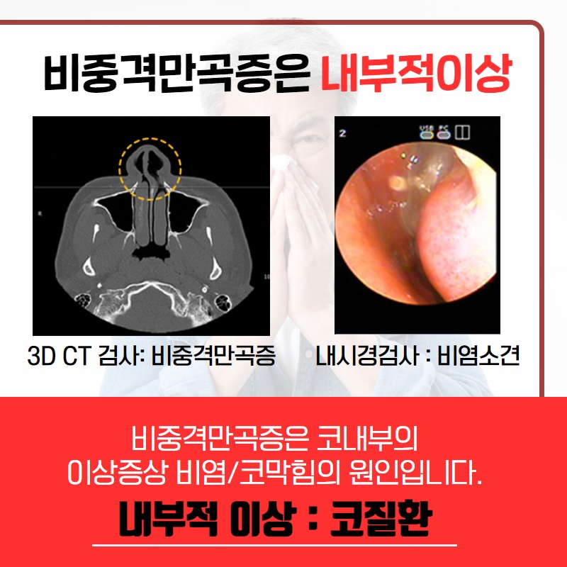 휜 코, 외모만의 문제일까? (3/10)