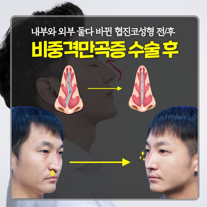 휜 코, 외모만의 문제일까? (7/10)