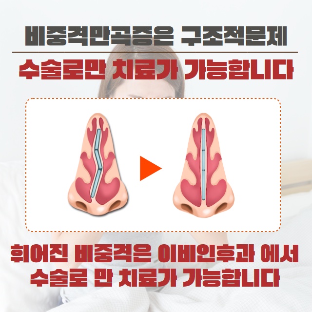 약물로는 치료 안되는 축농증(부비동염) 원인은 따로 있다!? (4/11)