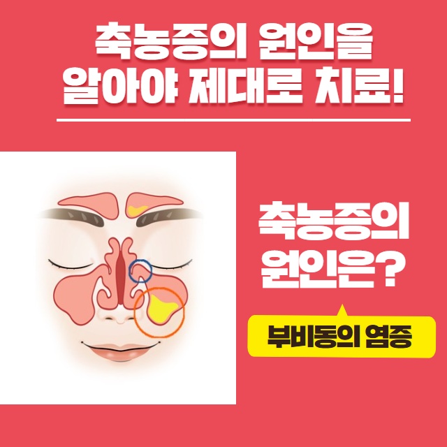 [수원이비인후과] 축농증(부비동염) 원인과 치료 방법! (4/15)
