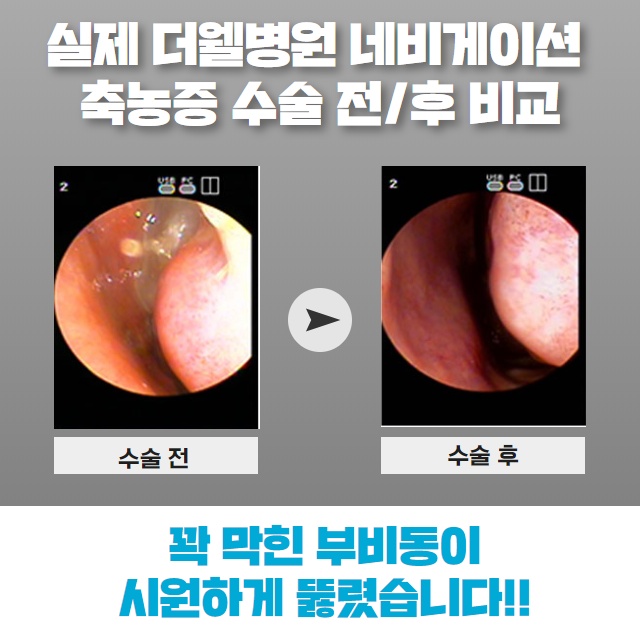 [수원이비인후과] 축농증(부비동염) 원인과 치료 방법! (11/15)