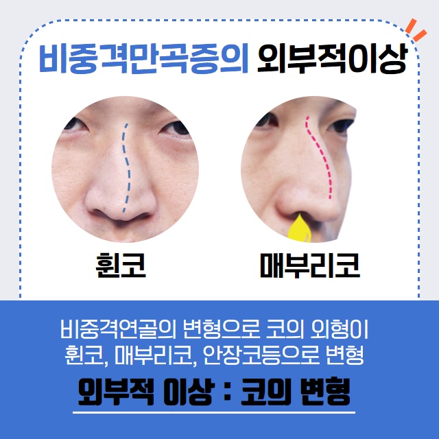 콧물이 주르륵 비염 코 세척과 비염치료. (9/14)