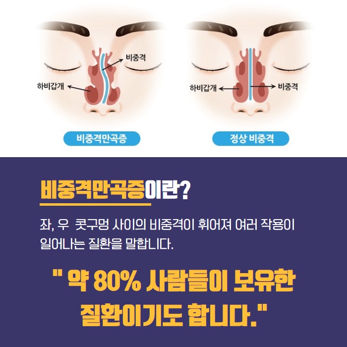 매부리코 휜코 교정 수술 어디서 해야 할까? (2/9)