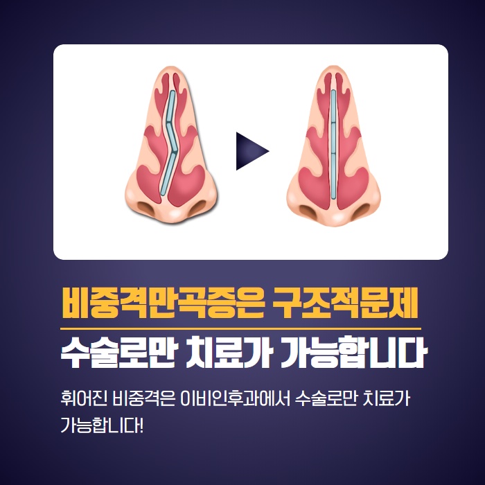 매부리코 휜코 교정 수술 어디서 해야 할까? (4/9)