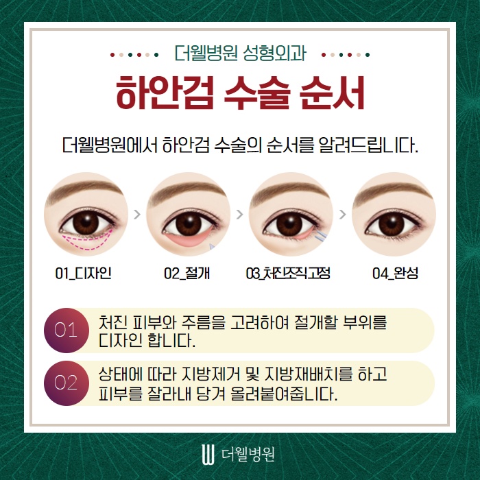 노화의 시작! 눈 밑처짐... 하안검 수술에 대해서 알아볼까요? (4/10)