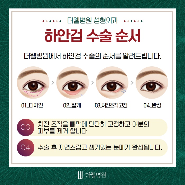 노화의 시작! 눈 밑처짐... 하안검 수술에 대해서 알아볼까요? (5/10)