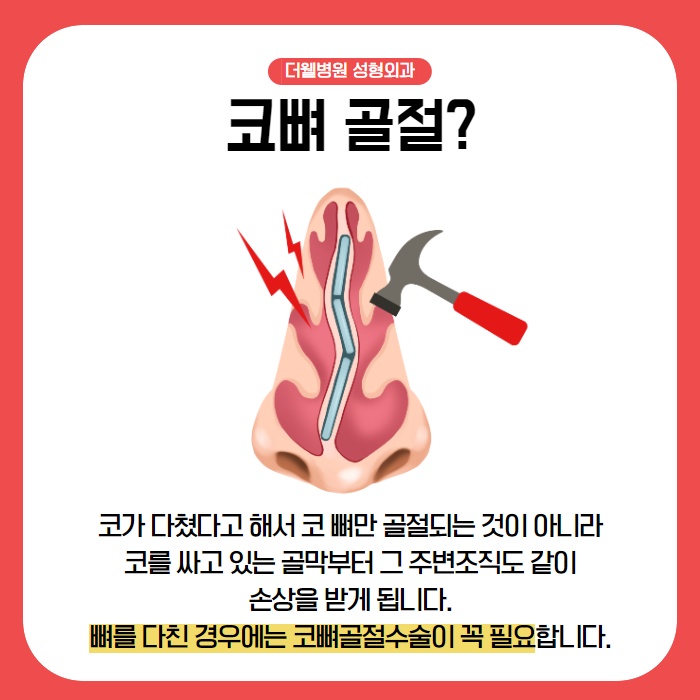 수원 코뼈골절, 골든타임이란? (2/9)