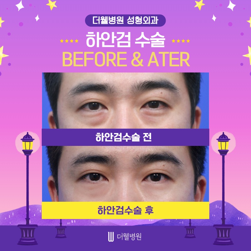 노화의 시작! 눈 밑 처짐! (8/10)