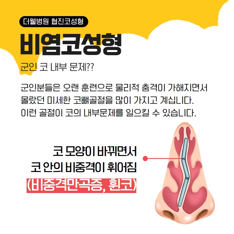 군인 휴가 중 코성형 가능할까? (3/11)