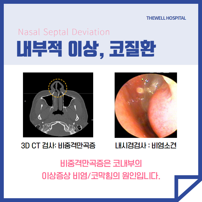 답답한 코막힘의 원인 비중격만곡증! (3/10)