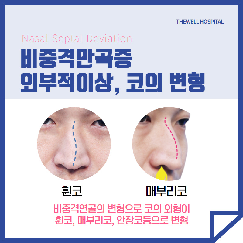 답답한 코막힘의 원인 비중격만곡증! (5/10)