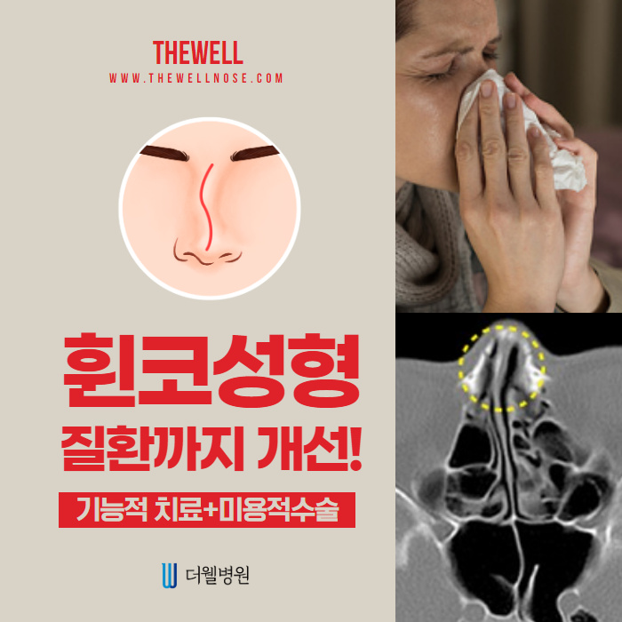 휜 코 성형, 질환까지 개선하자! (1/10)