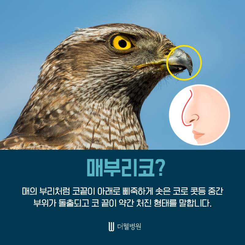 매부리코 수술, 코막힘도 확인하세요! (2/9)