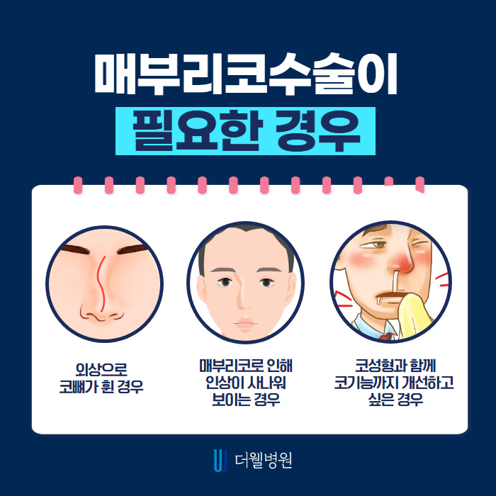 매부리코! 질환도 함께 개선하면 일석이조! (3/10)
