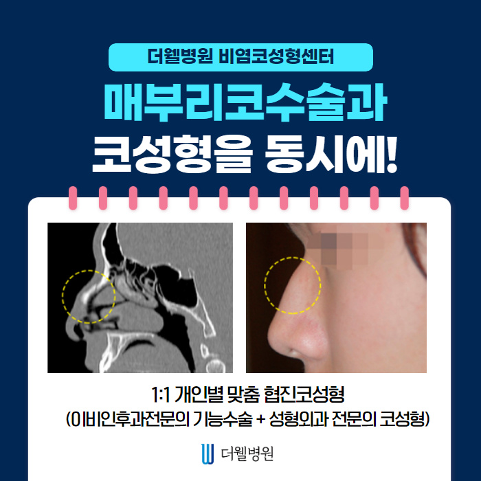 매부리코! 질환도 함께 개선하면 일석이조! (6/10)