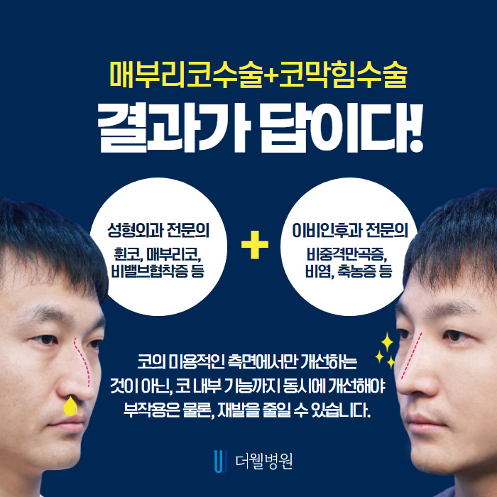 매부리코! 질환도 함께 개선하면 일석이조! (7/10)