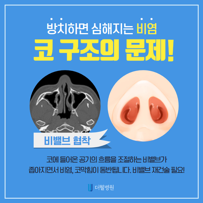 비염수술로 막힌 코를 시원하게! (5/9)