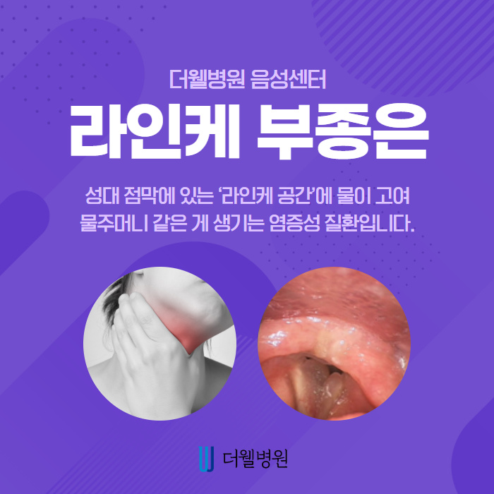 담배 피우시는 분들, 라인케 부종 조심하세요! (2/11)