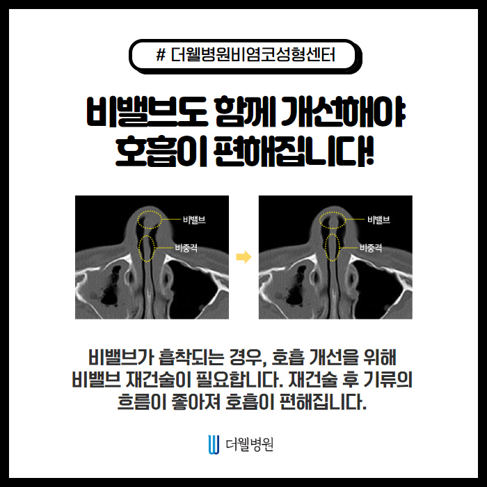 비중격만곡증을 무찌르러 왔다! (6/10)