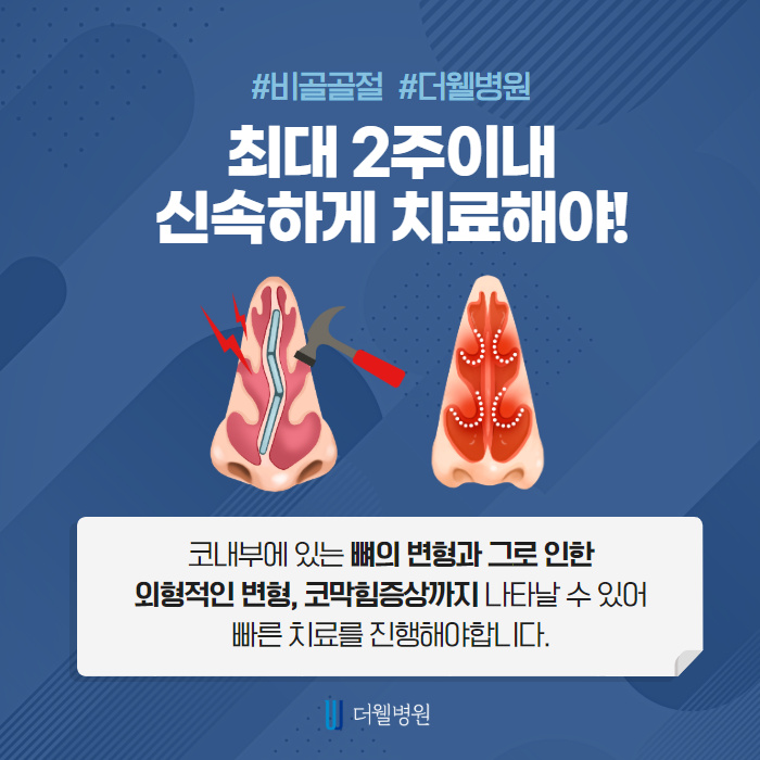 코 뼈가 부러졌다면 신속하게 치료! (3/10)