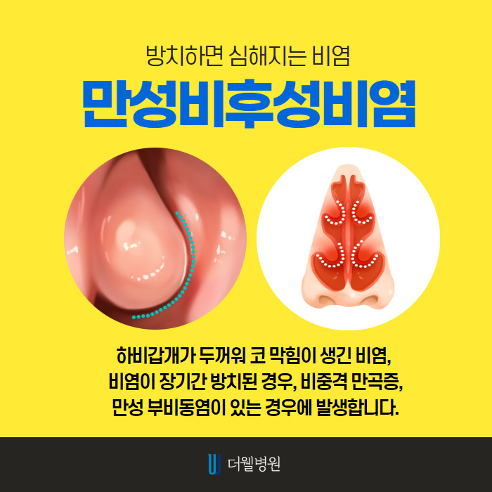 비염수술을 해야하는 이유?! (4/10)