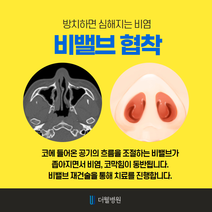 비염수술을 해야하는 이유?! (5/10)