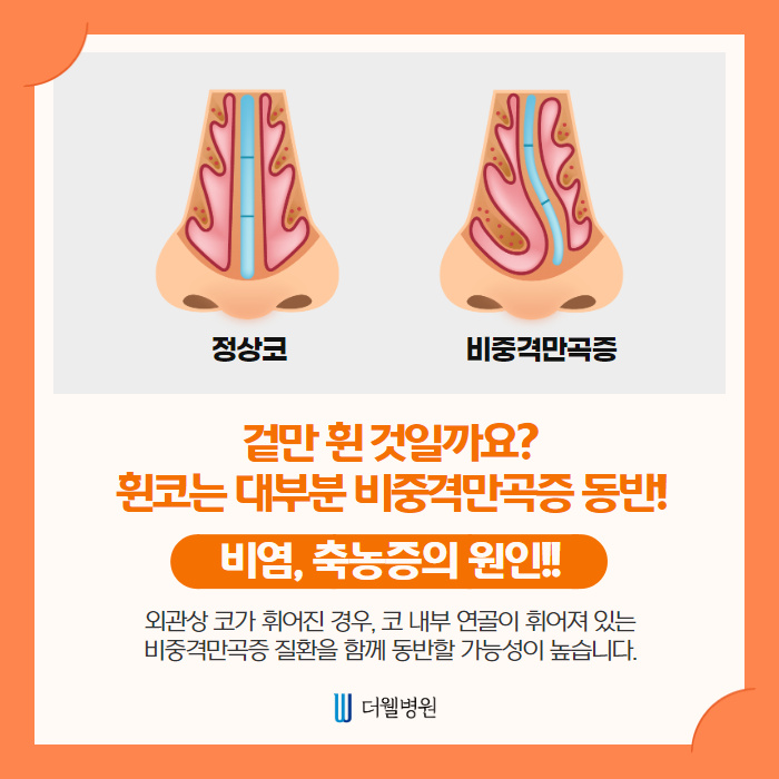 휜 코 개선할 때 비중격만곡증 동시에 개선하세요~ (2/10)