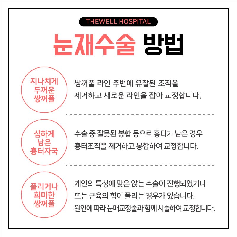 눈 재수술, 더 신중하게 결정하세요! (4/10)