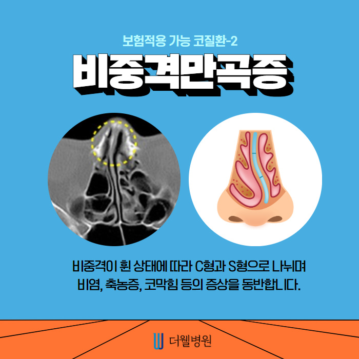 비염수술과 코성형은 무슨관계가 있나요? (4/11)