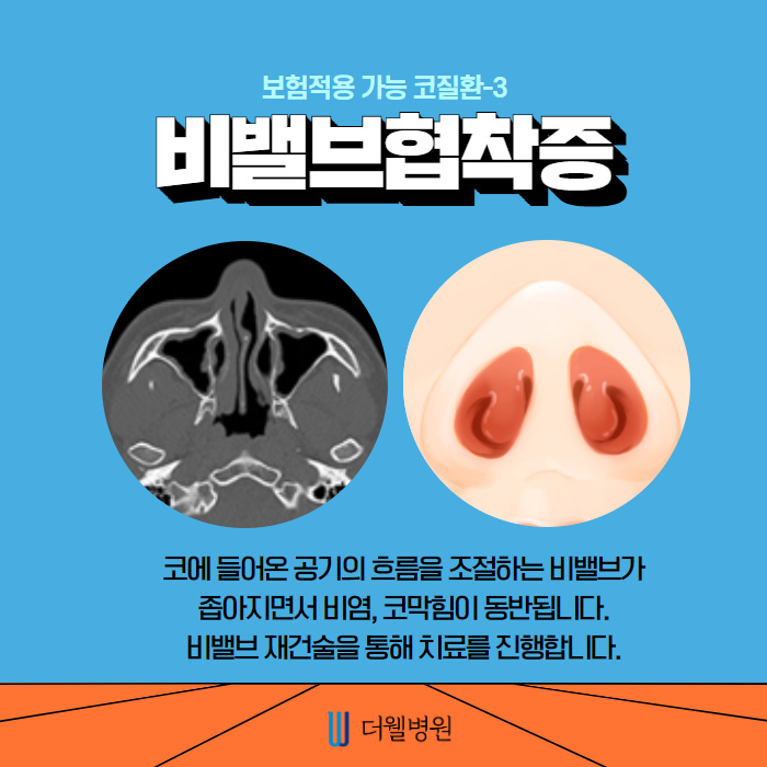 비염수술과 코성형은 무슨관계가 있나요? (5/11)