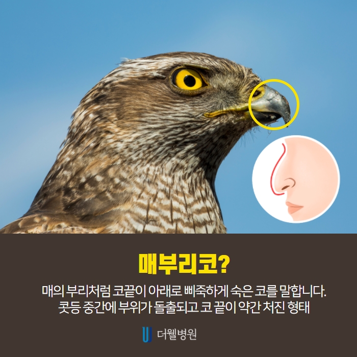 매부리코수술 코막힘 확인? (2/7)