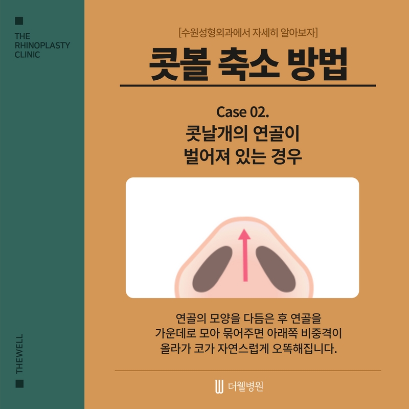 복코 수술, 수원성형외과에서 자세히 알아보자 (6/7)