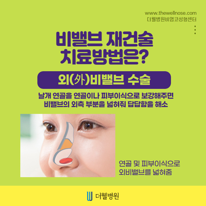 더웰병원 비밸브재건술