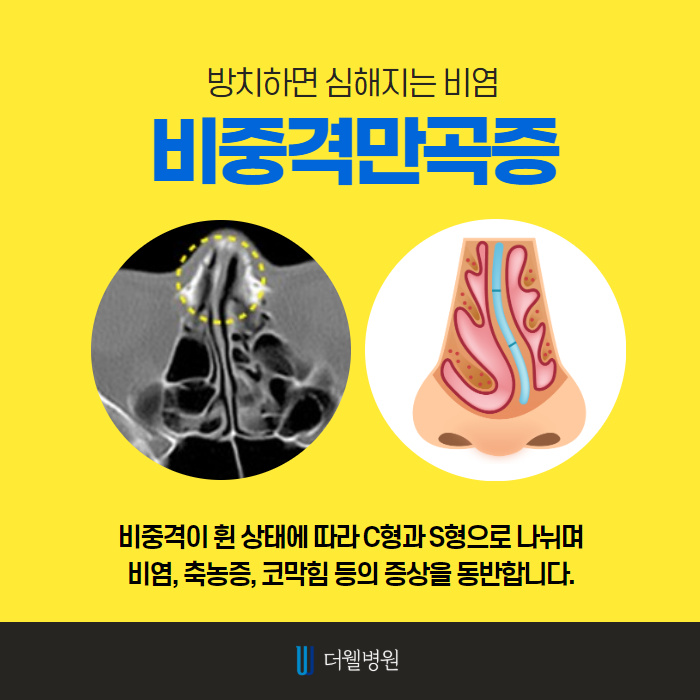 더웰병원 비염 수술