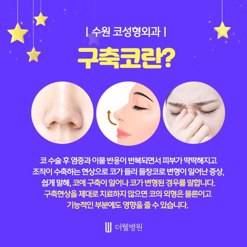 더웰병원 코 재수술
