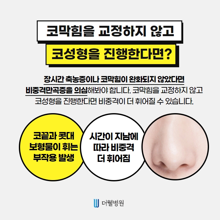 더웰병원 콧볼 축소술