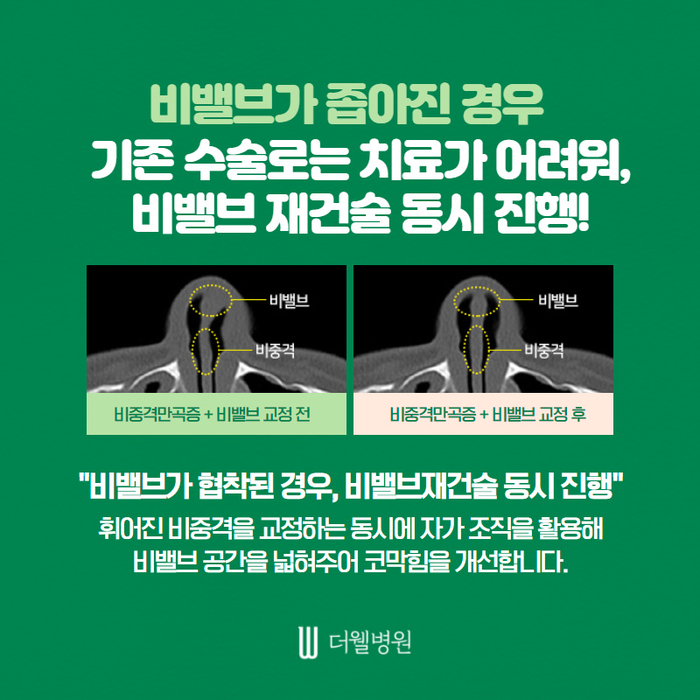 더웰병원 휜코 교정
